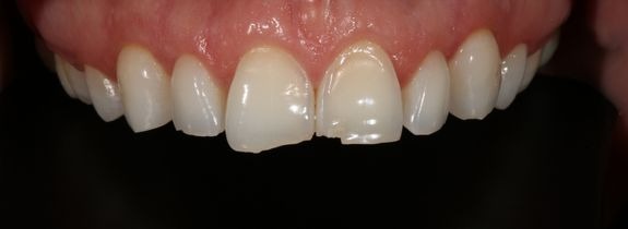 Composite Veneers