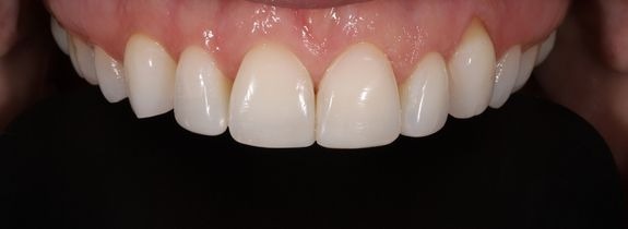 Composite Veneers