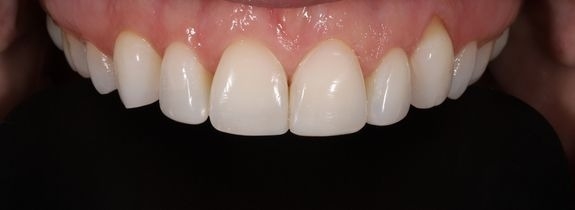Composite Veneers