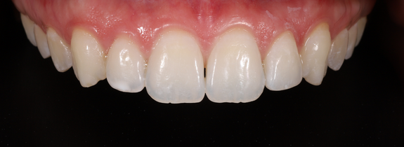 Invisalign®, Whitening, Bonding (1 tooth)