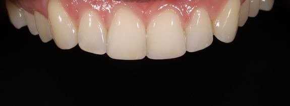Composite bonding