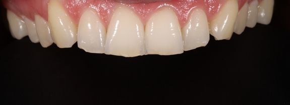 Composite bonding