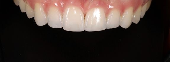 Whitening & Bonding (plus nightguard)