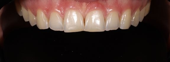 Whitening & Bonding (plus nightguard)