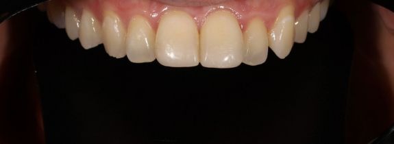 Composite Veneers