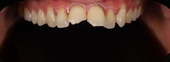 Composite Veneers