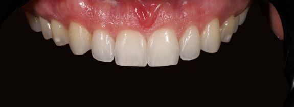 Invisalign®, Whitening, Bonding (2 Teeth)