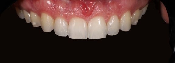 Invisalign®, Whitening, Bonding (2 Teeth)