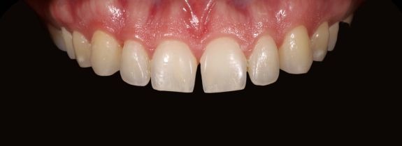 Invisalign®, Whitening, Bonding (2 Teeth)