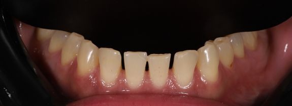 Composite Bonding (6 lower composites)
