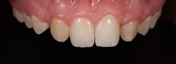 Composite Veneers Whitening and Gum Lift