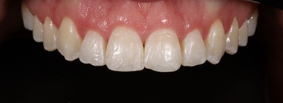 Composite Veneers, Whitening and Gum Lift