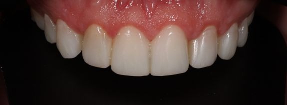 Composite Veneers Whitening and Gum Lift