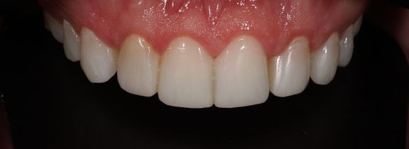 Composite Veneers Whitening and Gum Lift