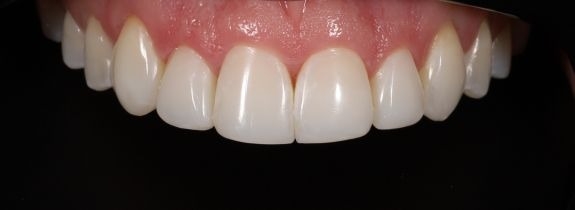 Composite Veneers, Whitening and Gum Lift