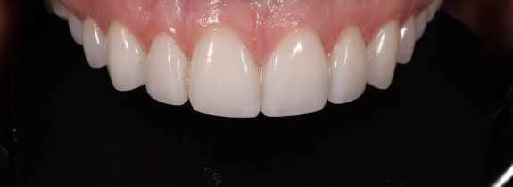 Porcelain veneers