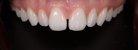 Porcelain veneers