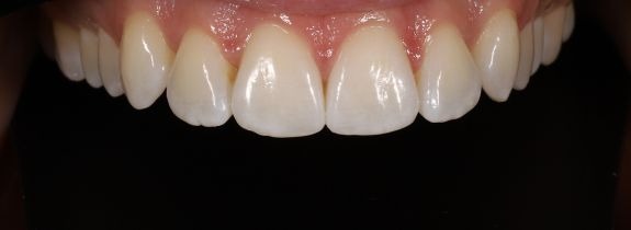 Upper arch Invisalign and Whitening