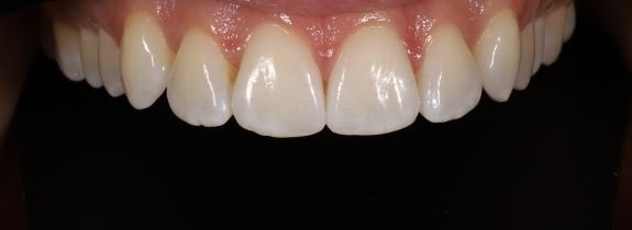 Upper arch Invisalign and Whitening