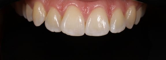 Upper arch Invisalign and Whitening