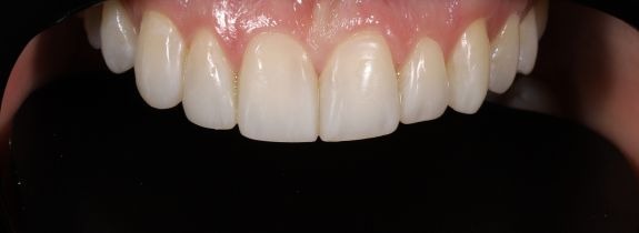 Composite Veneers & Whitening