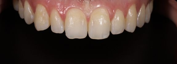 Composite Veneers & Whitening