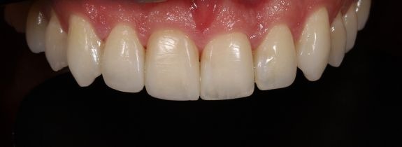 Composite Veneers & Whitening