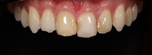 Composite Veneers & Whitening