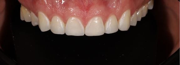 Composite Veneers & Whitening