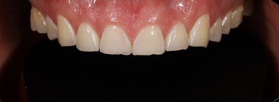 Composite Veneers & Whitening