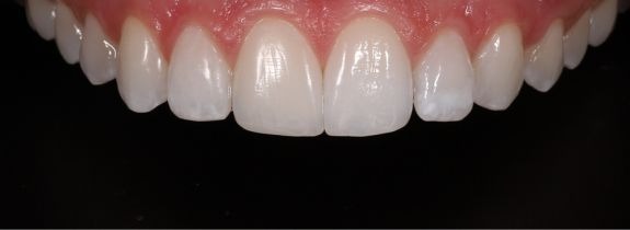 Invisalign, whitening and 1 composite veneer