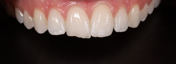 Invisalign, whitening and 1 composite veneer