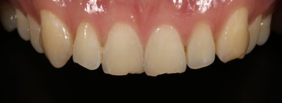 Whitening and Bonding