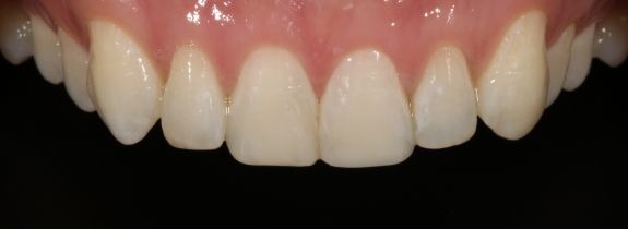 Whitening and Bonding