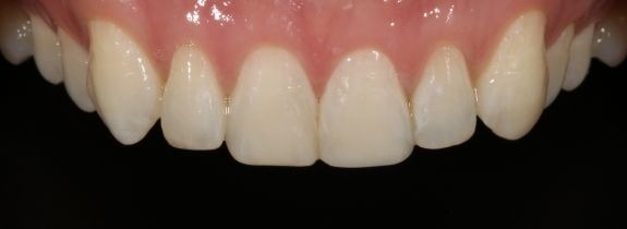 Whitening and Bonding