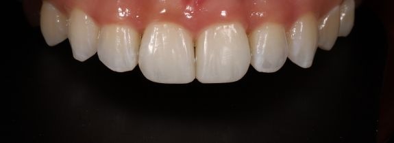 Invisalign, Whitening and 2 Composite Veneers