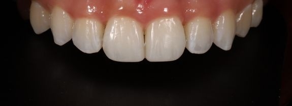 Invisalign, Whitening and 2 Composite Veneers