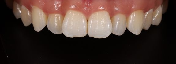 Invisalign, Whitening and 2 Composite Veneers