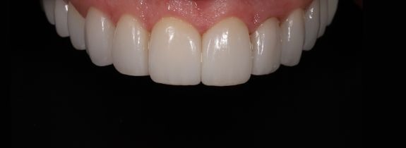 Porcelain veneers
