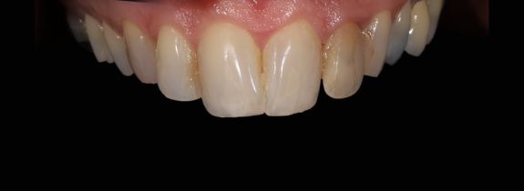Porcelain veneers