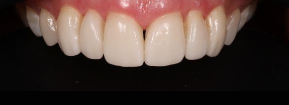 Porcelain veneers