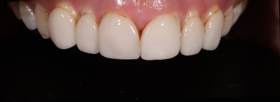 Porcelain veneers