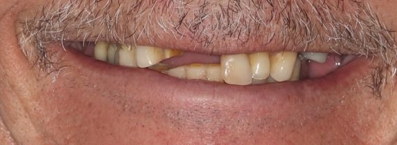 All-on-4® dental implants