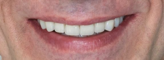 Full mouth rehabilitation with implants