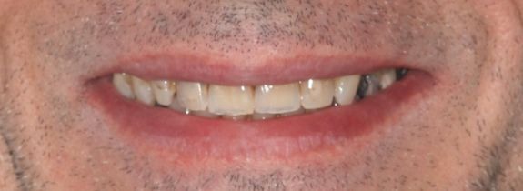 Full mouth rehabilitation with implants