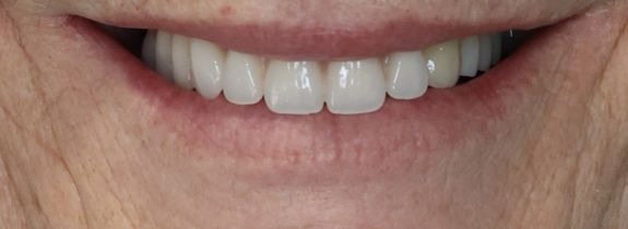 Small Fixed implant bridge