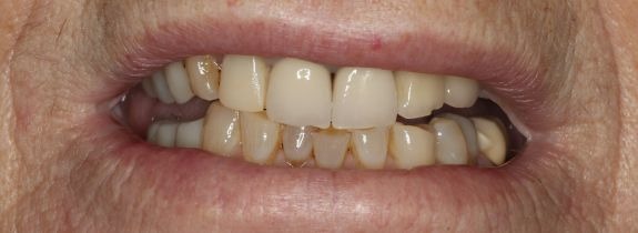 Small Fixed implant bridge