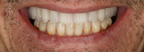 Upper All-on-4® implant bridge