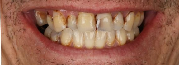 Upper All-on-4® implant bridge