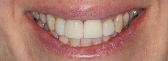 Immediate (same-day) implant